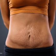 Junge Mutter steht mit den Armen hinter dem Rücken und zeigt ihren gedehnten Bauch mit Schwangerschaftsstreifen nach der Schwangerschaft zum Thema Nach der Schwangerschaft: Was ist ein Mommy Makeover?