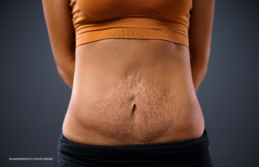 Junge Mutter steht mit den Armen hinter dem Rücken und zeigt ihren gedehnten Bauch mit Schwangerschaftsstreifen nach der Schwangerschaft zum Thema Nach der Schwangerschaft: Was ist ein Mommy Makeover?