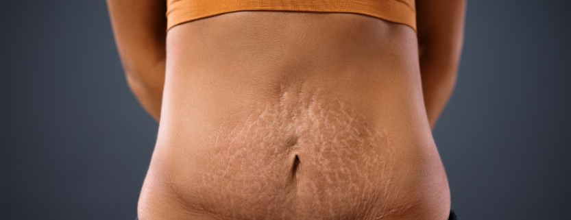 Junge Mutter steht mit den Armen hinter dem Rücken und zeigt ihren gedehnten Bauch mit Schwangerschaftsstreifen nach der Schwangerschaft zum Thema Nach der Schwangerschaft: Was ist ein Mommy Makeover?