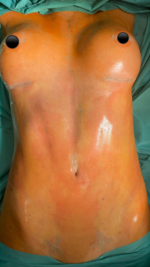Mit High Definition Body Contouring zu einer besseren Körperform